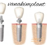 کلینیک تخصصی ونک ایمپلنت