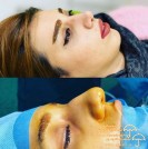 nose-rhinoplasty-parisa-moghadam-doctor