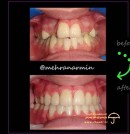 after-before-orthodontics-dental-teeth