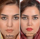 nose-surgery-rhinoplasty-before-after-shiraz