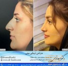 nose-surgery-rhinoplasty-face-change