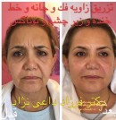 botox-old-woman-beauty