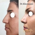 nose-job-before-after-beauty-clinic-rhinoplasty