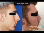 nose-job-qazvin-beauty-clinic-shapoor-safari