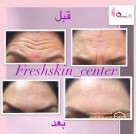 forehead-botox-clinic-before-after