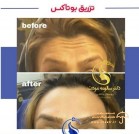 forehead-botox-woman-before-after