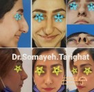 doctor-somaye-tarighat-rhinoplasty-before-after