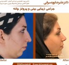 before-after-doctor-pourseirafi-rhinoplasty-before-after