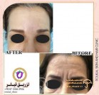 forehead-filler-before-after-rukal-beauty-clinic